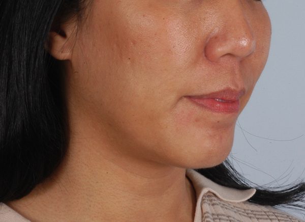 Chin Advancement Case 1198 After Photo Chin Advancement