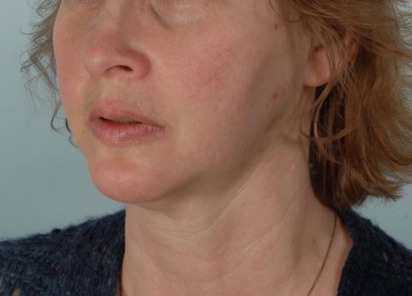Chin Advancement Case 1199 After Photo Chin Advancement