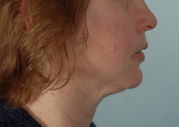 Chin Advancement Case 1199 After Photo Chin Advancement