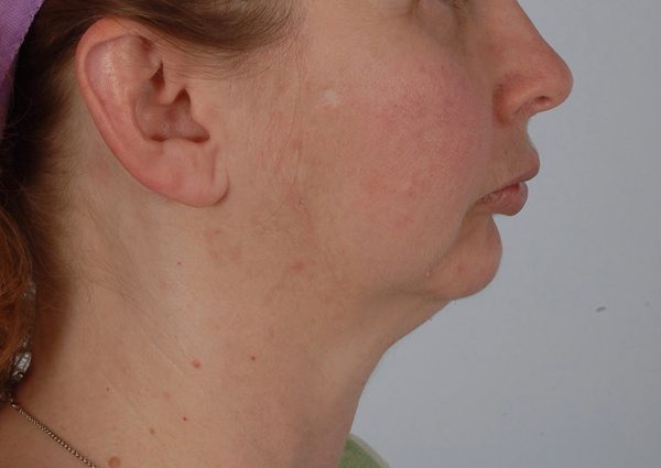 Chin Advancement Case 1199 Before Photo Chin Advancement