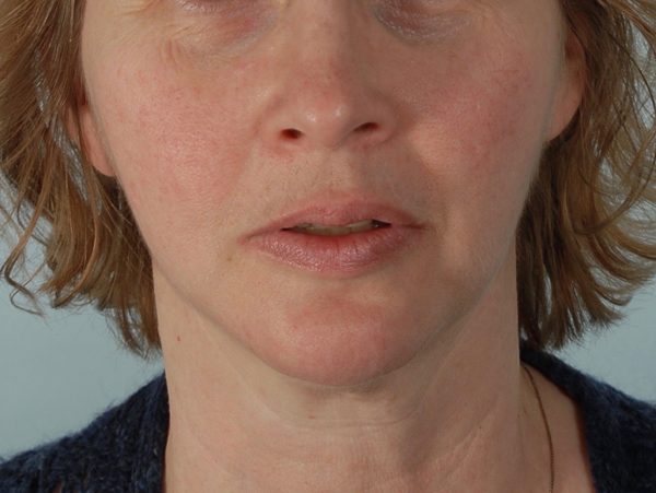 Chin Advancement Case 1199 After Photo Chin Advancement