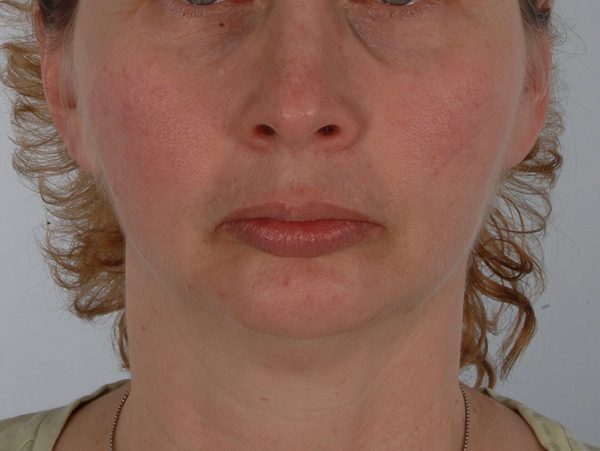 Chin Advancement Case 1199 Before Photo Chin Advancement