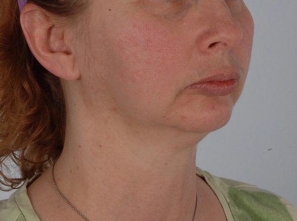 Chin Advancement Case 1199 Before Photo Chin Advancement