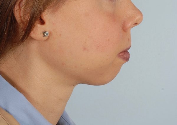 Chin Advancement Case 1200 Before Photo Chin Advancement