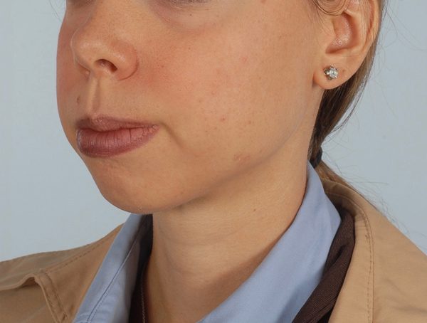 Chin Advancement Case 1200 Before Photo Chin Advancement