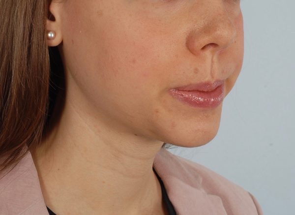 Chin Advancement Case 1200 After Photo Chin Advancement