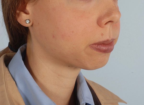 Chin Advancement Case 1200 Before Photo Chin Advancement