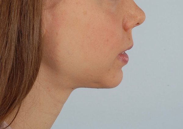Chin Advancement Case 1200 After Photo Chin Advancement