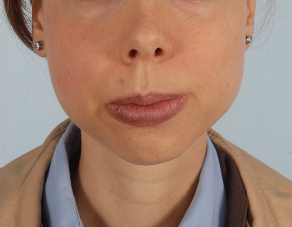 Chin Advancement Case 1200 Before Photo Chin Advancement