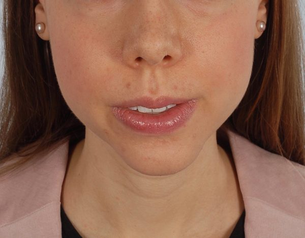 Chin Advancement Case 1200 After Photo Chin Advancement