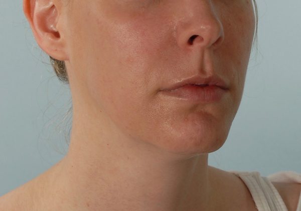 Chin Advancement Case 1201 After Photo Chin Advancement