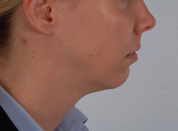 Chin Advancement Case 1201 Before Photo Chin Advancement