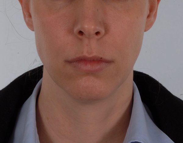 Chin Advancement Case 1201 Before Photo Chin Advancement