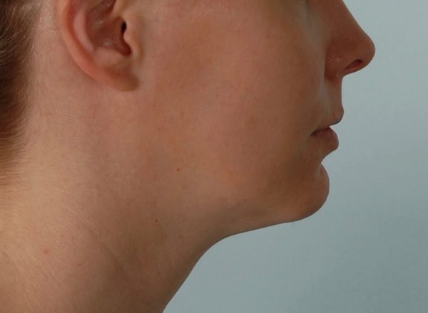 Chin Advancement Case 1201 After Photo Chin Advancement