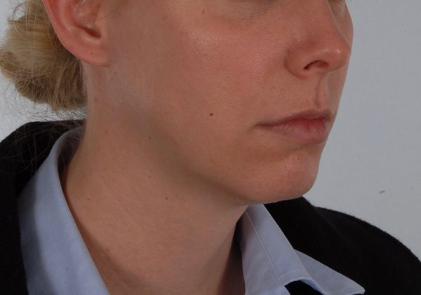 Chin Advancement Case 1201 Before Photo Chin Advancement