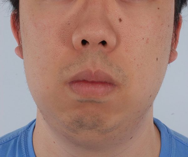 Chin Advancement Case 1202 Before Photo Chin Advancement