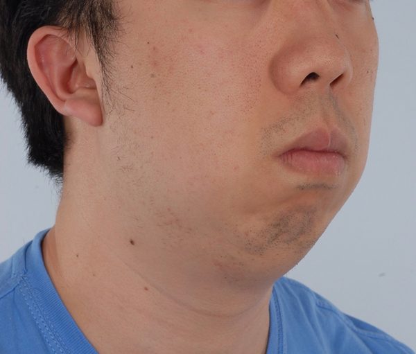 Chin Advancement Case 1202 Before Photo Chin Advancement