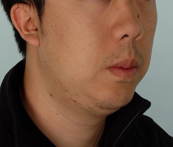Chin Advancement Case 1202 After Photo Chin Advancement