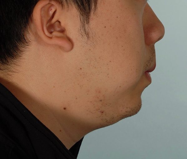 Chin Advancement Case 1202 After Photo Chin Advancement