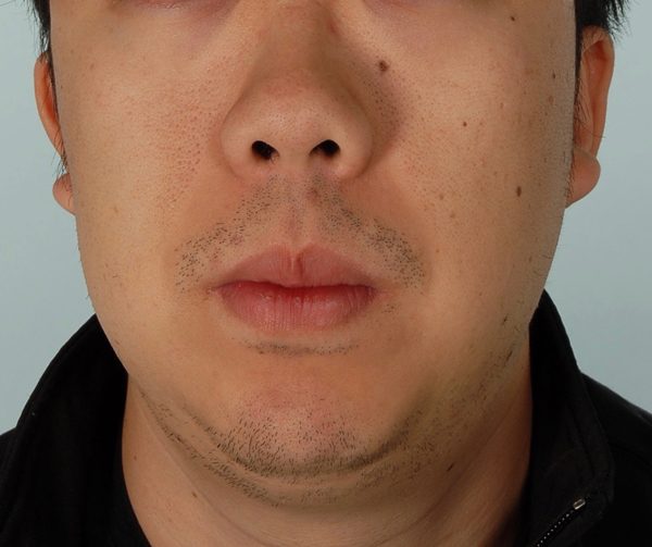 Chin Advancement Case 1202 After Photo Chin Advancement