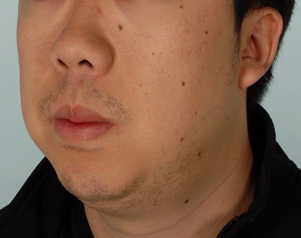 Chin Advancement Case 1202 After Photo Chin Advancement