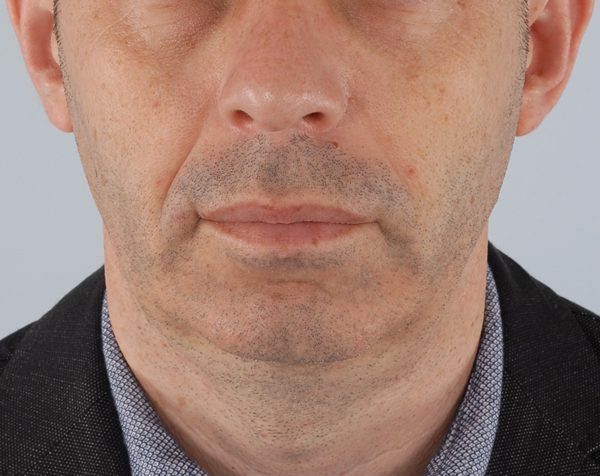 Chin Advancement Case 1203 Before Photo Chin Advancement