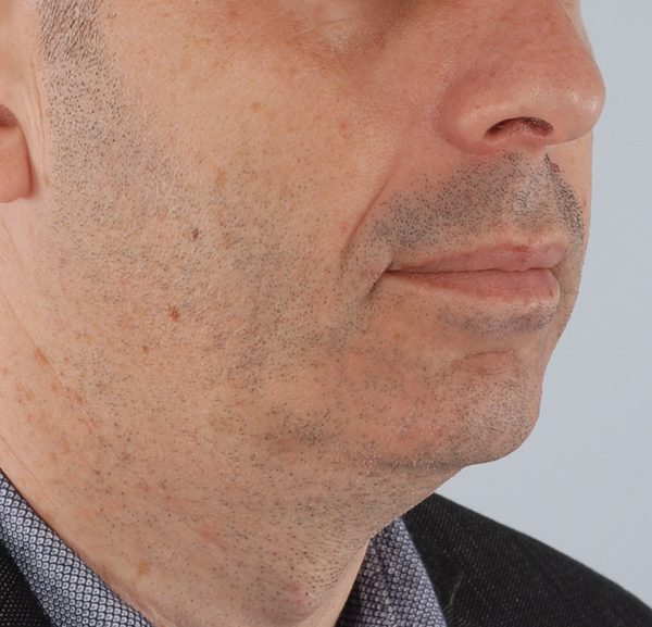 Chin Advancement Case 1203 Before Photo Chin Advancement