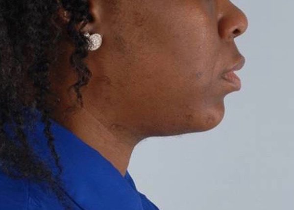 Chin Advancement Case 1205 After Photo Chin Advancement