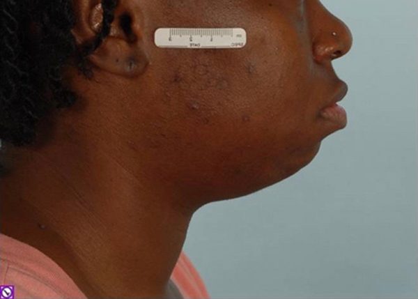 Chin Advancement Case 1205 Before Photo Chin Advancement