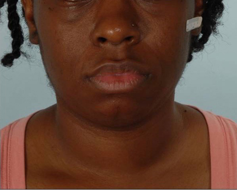 Chin Advancement Case 1205 Before Photo Chin Advancement