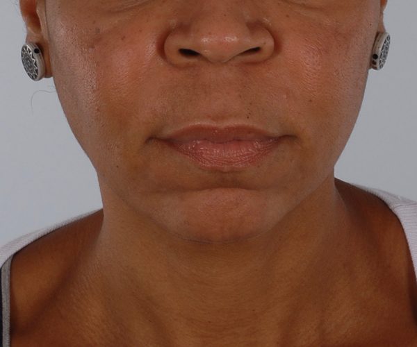Lip Surgery Case 1586 Before Photo Lip Surgery