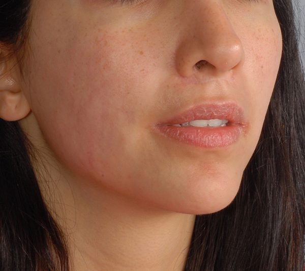 Lip Surgery Case 1608 After Photo Lip Surgery