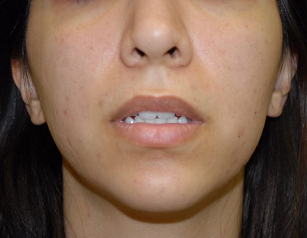 Lip Surgery Case 1608 Before Photo Lip Surgery