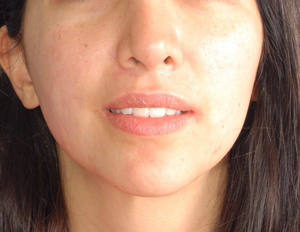 Lip Surgery Case 1608 After Photo Lip Surgery
