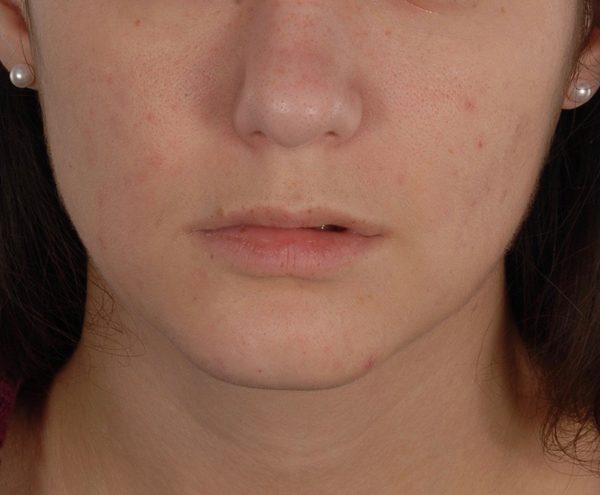 Lip Surgery Case 1616 Before Photo Lip Surgery