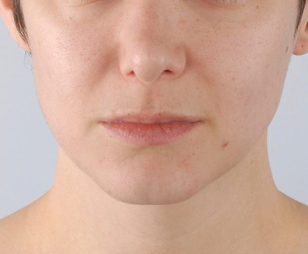 Lip Surgery Case 1616 After Photo Lip Surgery