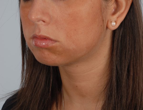 Chin Asymmetry