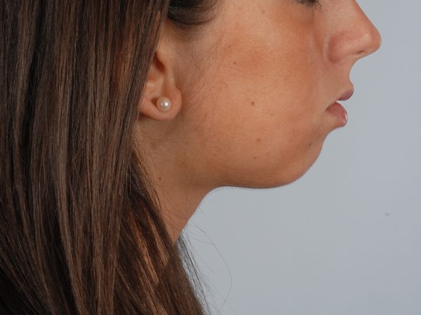 Chin Asymmetry