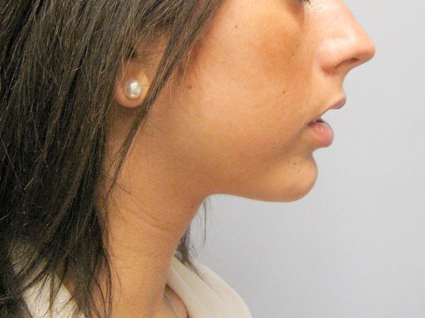 Chin Asymmetry