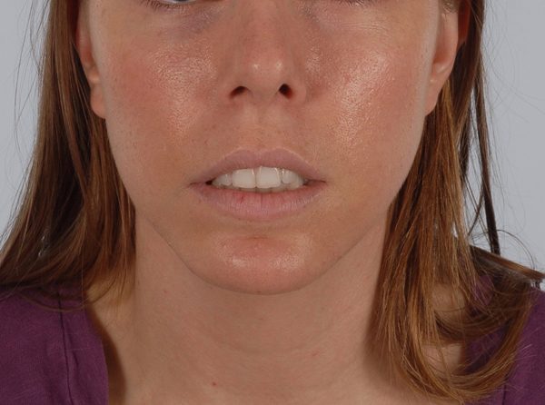 Chin Asymmetry Case 1648 After Photo Chin Asymmetry