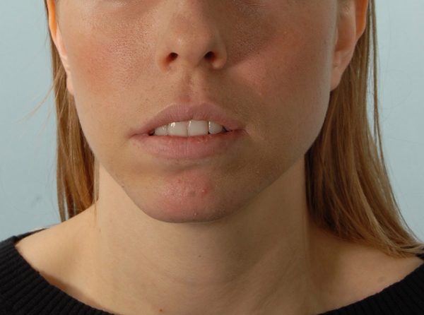 Chin Asymmetry Case 1648 Before Photo Chin Asymmetry