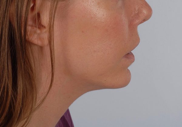 Chin Asymmetry Case 1648 After Photo Chin Asymmetry