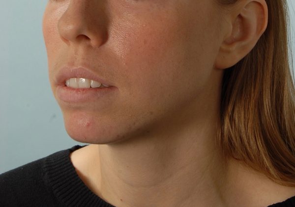 Chin Asymmetry Case 1648 Before Photo Chin Asymmetry