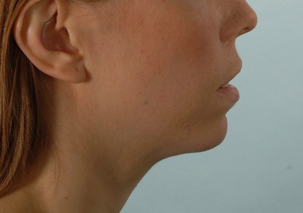 Chin Asymmetry Case 1648 Before Photo Chin Asymmetry