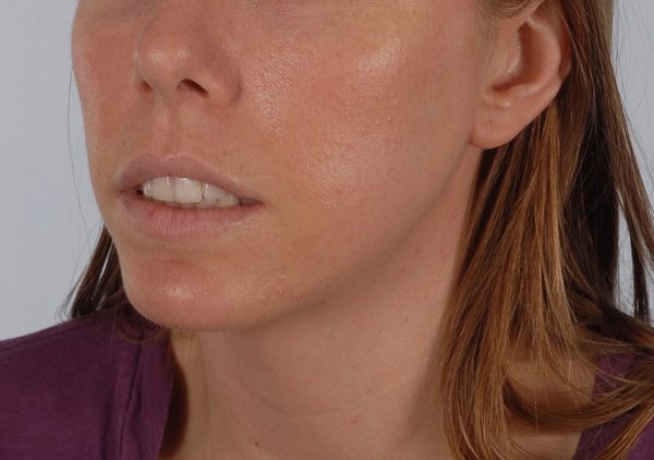 Chin Asymmetry Case 1648 After Photo Chin Asymmetry