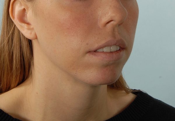 Chin Asymmetry Case 1648 Before Photo Chin Asymmetry