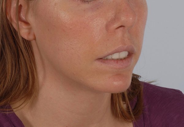Chin Asymmetry Case 1648 After Photo Chin Asymmetry