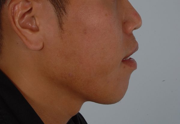 Chin Narrowing Case 1658 Before Photo Chin Narrowing