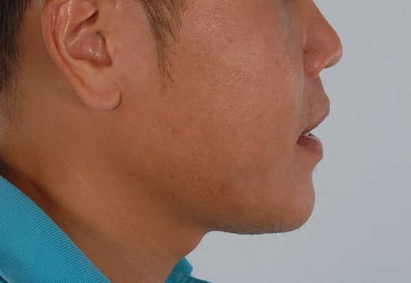 Chin Narrowing Case 1658 After Photo Chin Narrowing