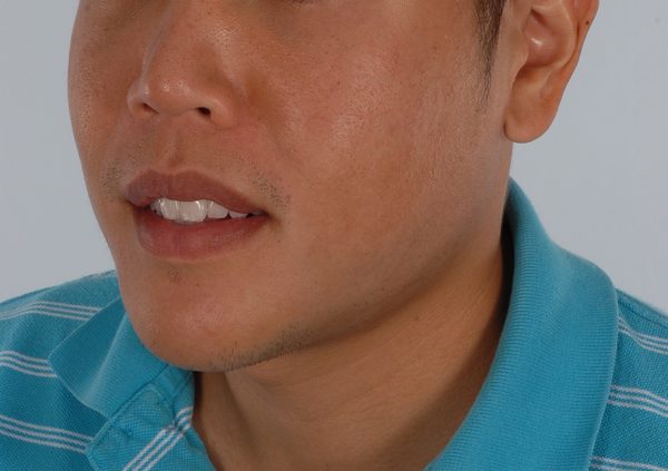 Chin Narrowing Case 1658 After Photo Chin Narrowing
